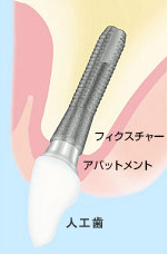 インプラント治療とは?